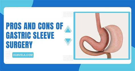 10+ Pros and Cons Of Gastric Sleeve Surgery » Hubvela