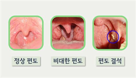 편도염 치료 어떻게 A22