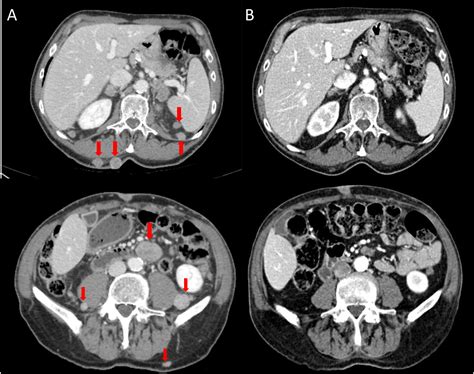 Immunotherapy-refractory, EGFR overexpressing metastatic porocarcinoma