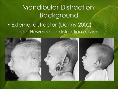 PPT - Early Mandibular Distraction Osteogenesis in Pierre Robin ...