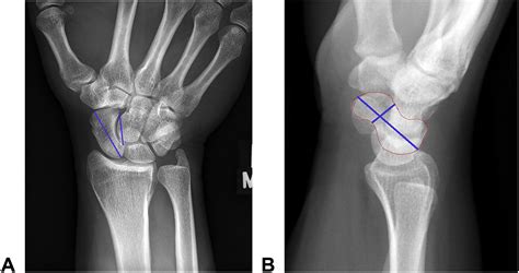 Avascular Necrosis Of The Scaphoid Preiser Disease Outcomes Of 39