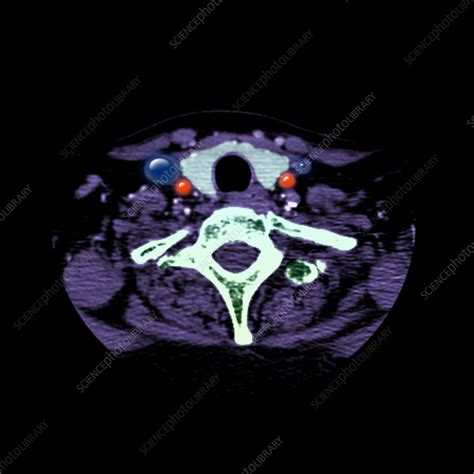 Normal Thyroid Ct Scan