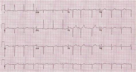 Left Anterior Fascicular Block Ina Ecg