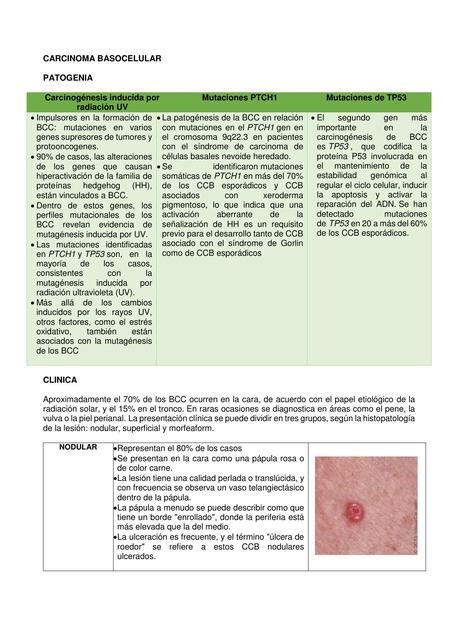 Carcinoma Basocelular Mariana Lizzeth Udocz