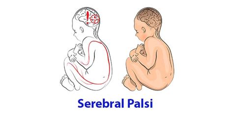 Serebral Palsi Nedir Nedenleri Belirtileri Ve Tedavisi