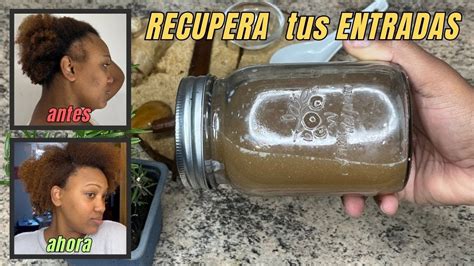 REMEDIO PARA HACER CRECER EL CABELLO DE LAS ENTRADAS Cómo Recuperar