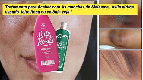 Tratamento Para Acabar Com As Manchas De Melasma Axilasvirilhausando