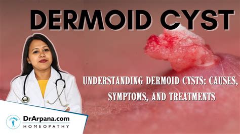 Understanding Dermoid Cysts Causes Symptoms Diagnosis And Management