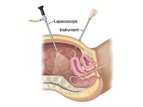 Laparoscopic Surgery In Faridabad Delhi Ncr Dr Arun Pandey