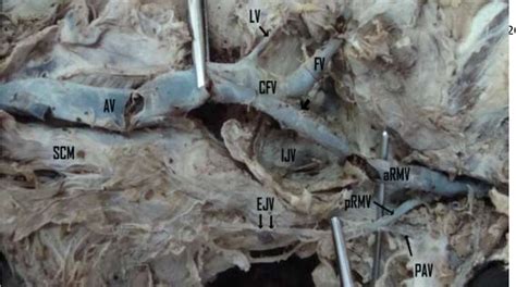 Figure 2 from VARIANT ANATOMY OF THE EXTERNAL JUGULAR VEIN | Semantic ...