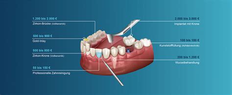 Zahnersatz Möglichkeiten und Kosten Magazin WISSEN