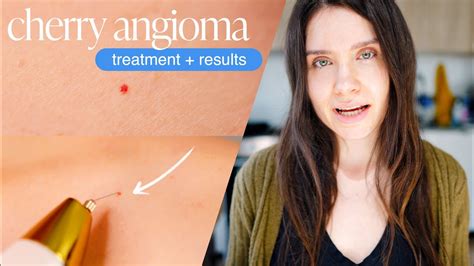 How To Get Rid Of Cherry Angiomas Moles Red Skin Dots Plasma Pen