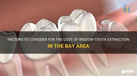 Factors To Consider For The Cost Of Wisdom Tooth Extraction In The Bay