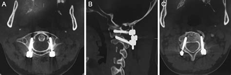 Type Ii Odontoid Fracture Treated With C1 Pedicle And C2 Pedicle Screw