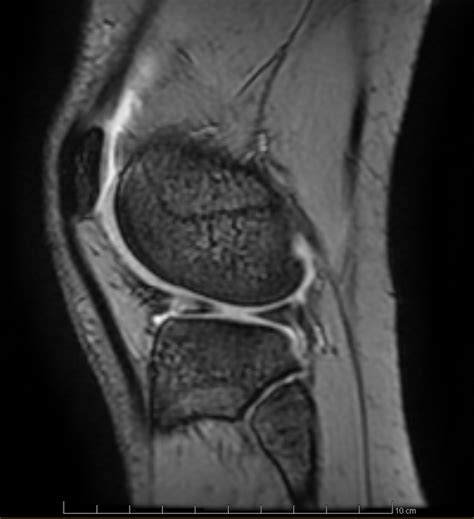 MRI of an actual Lateral Meniscus tear : r/Radiology