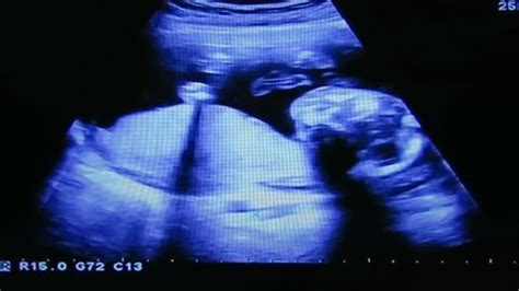 Baby Boy Ultrasound 20 Weeks Arm Stock Footage Video (100% Royalty-free ...