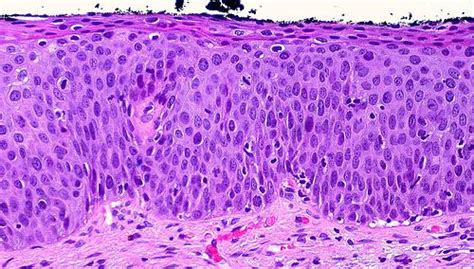 Células Epiteliais Escamosas Características E Doenças