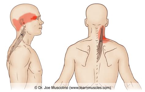 Splenius Cervicis - Trigger Points - Learn Muscles