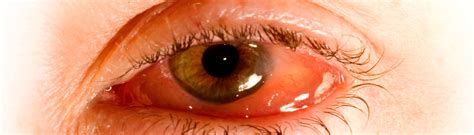 Eye diseases | healthdirect