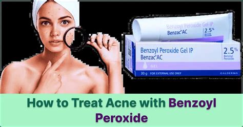 How To Treat Acne With Benzoyl Peroxide