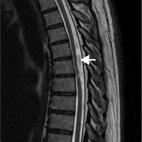 Sagittal T2 Mri Images Demonstrating A Dorsally Placed Intradural Download Scientific Diagram