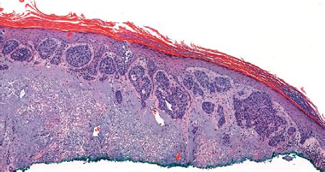 Squamoid Eccrine Ductal Carcinoma Cytologically Atypical Squamoid