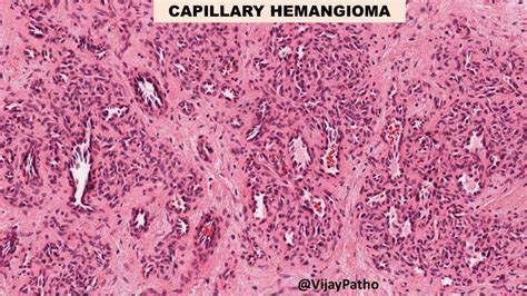 Capillary Hemangioma Pathology Made Simple