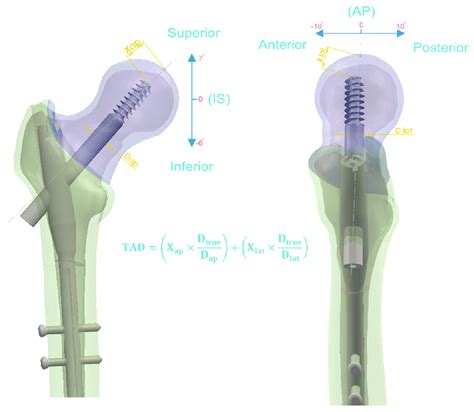 Simulation Of Ao 31 A1 Fracture And Description Of Tip Apex Distance