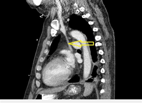 Chest Computerized Tomography CT Scan Sagittal View With Contrast