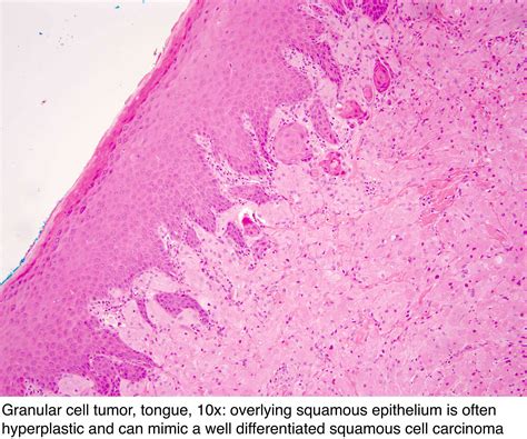 Pathology Outlines Granular Cell Tumor