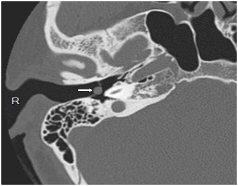 A Tympanic Membrane Cholesteatoma A Case Report And Literature Review