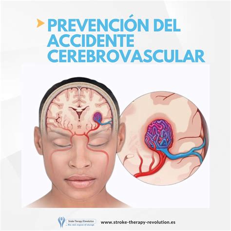 Prevención Del Accidente Cerebrovascular Stroke Therapy Revolution