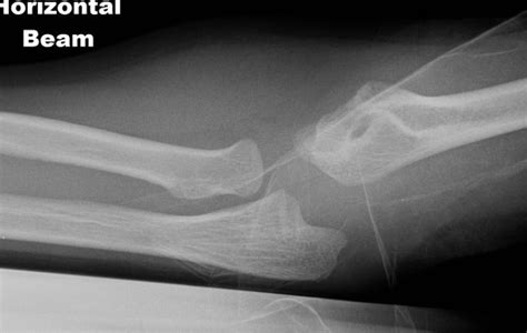 Lateral Condyle Fractures The Bone School