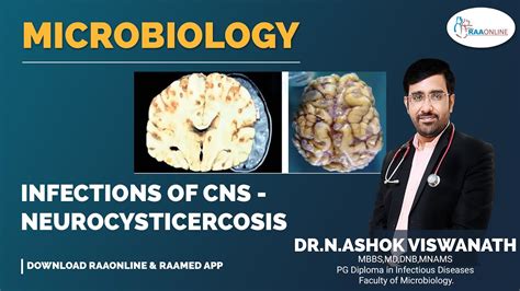 Infections Of Central Nervous System Neurocysticercosis Youtube