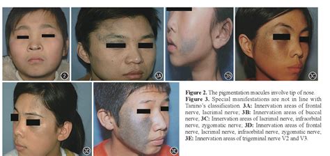 Figure 3 From A New Classification Of Nevus Of Ota Semantic Scholar