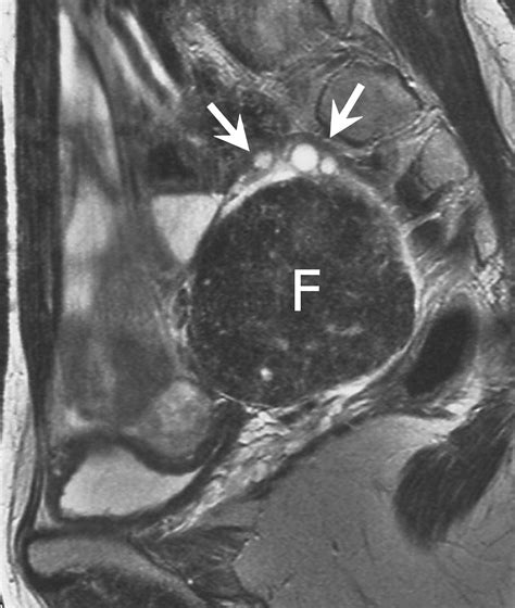 References In Mri Features Of Ovarian Fibromas Emphasis On Their