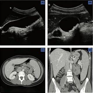 Imaging Studies (A) Ultrasound long‐axis view—cholelithiasis; (B ...