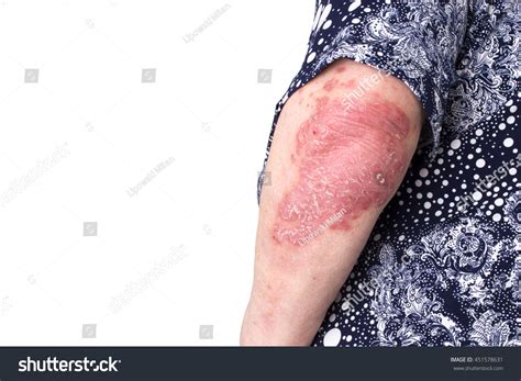 Detail Of Psoriasis Vulgaris, Skin Disease Stock Photo 451578631 ...