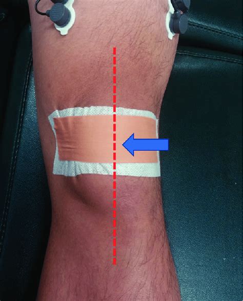 The Effects Of McConnell Patellofemoral Joint And Tibial Internal