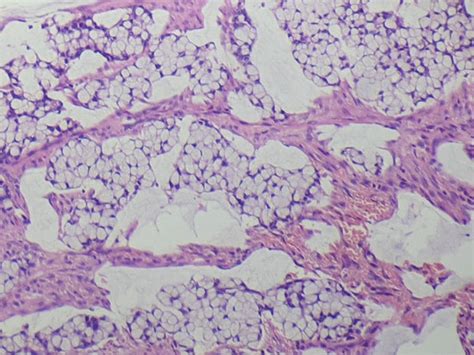 A Photomicrograph Of Primary Signet Ring Cell Carcinoma Of The Sigmoid Download Scientific