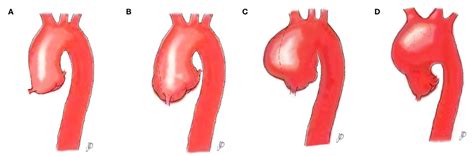 Bicuspid Aortic Valve