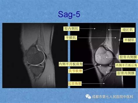 影像解剖 膝关节mri高清解剖图解 中国医疗