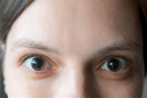 Close Up Of A Womans Brown Eyes With Dilated Big Pupils After Eye