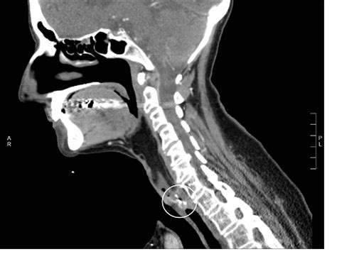 Figure 1 From Endoscopic Removal Of A Displaced Tracheoesophageal Voice