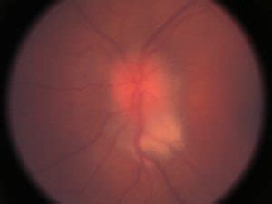 Moran Core Optic Nerve And Macular Oct In Hurler Syndrome Mps I