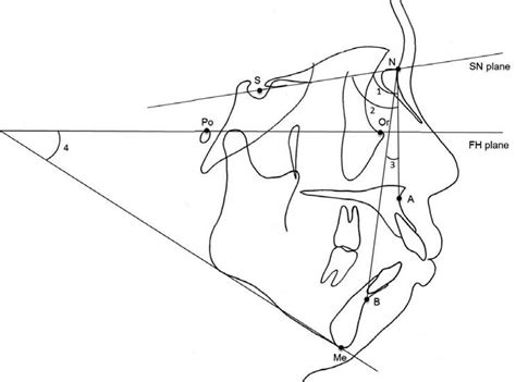 Angular Measurements Of Hard Tissue 1 ∠sna 2 ∠snb 3 ∠anb 4 Download Scientific