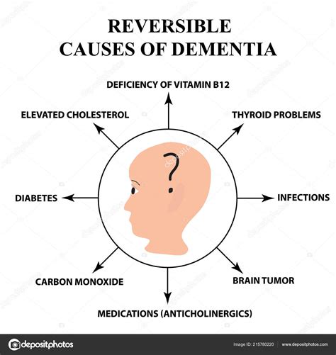 Reversible causes of senile dementia. Alzheimer's disease. Infographics ...