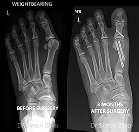 Minimally Invasive Bunion Surgery Perth Dr Simon Zilko St Mtp