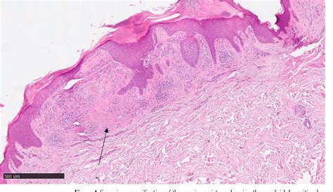 Figure From Lichen Amyloidosis In An Atopic Patient Treated With