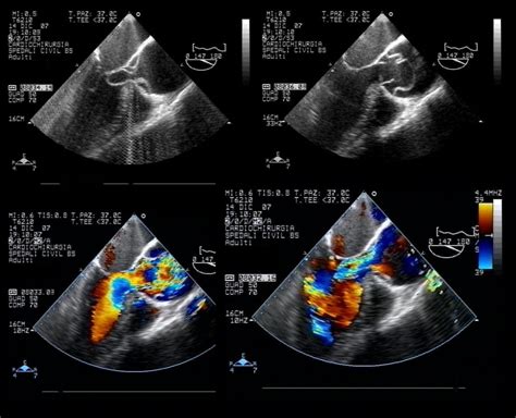 Transesophageal Echocardiogram Aorta